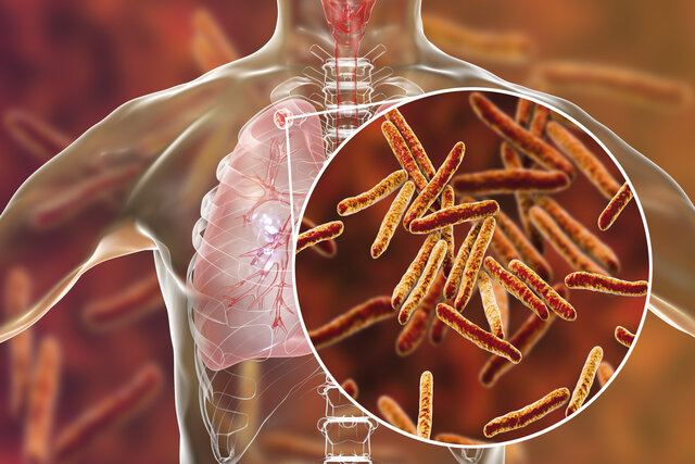 Tuberculosis y Fiebre Tifoidea