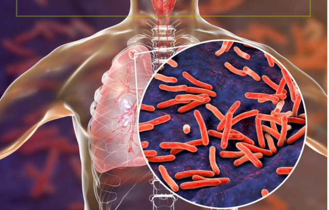 Tuberculosis enfrentada exitosamente