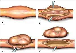 Removed schwannoma tumor
