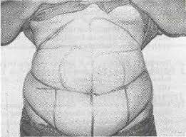 Y. G. Illouz inició la técnica de la liposucción