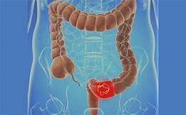 Burkitt, Walker y Painter