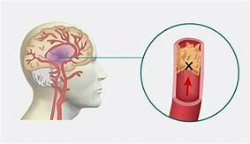 Enfermedad Cerebrovascular