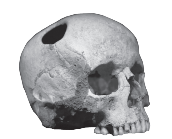 Medicina prehistórica y  primitiva