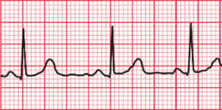 Electrocardiogramas