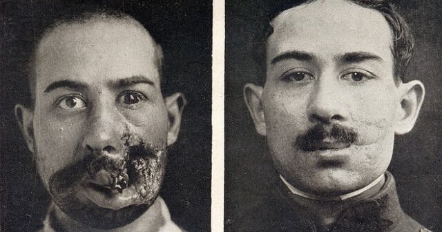 Cirugía Plástica Post Guerra