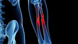 Cuando me fracturé la tibia