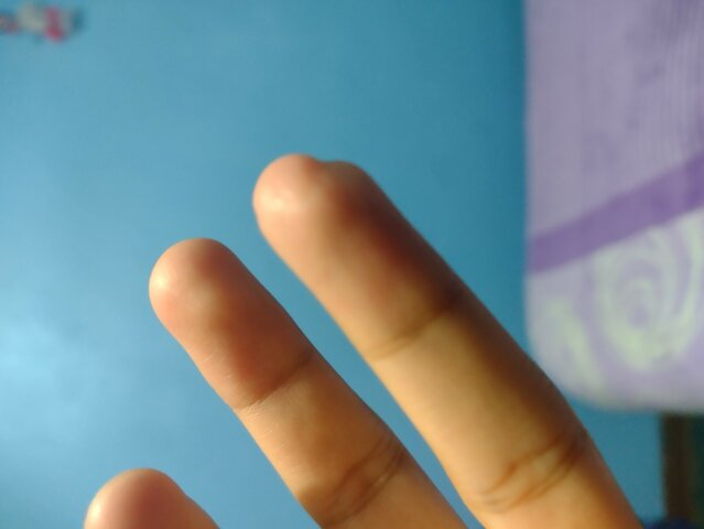 my bad finger/ dedo mocho