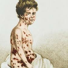 Vacuna contra la viruela