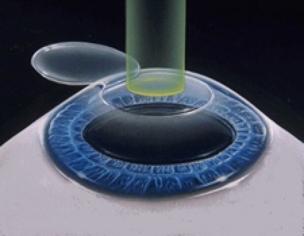 PMMA en cirugia Ocular