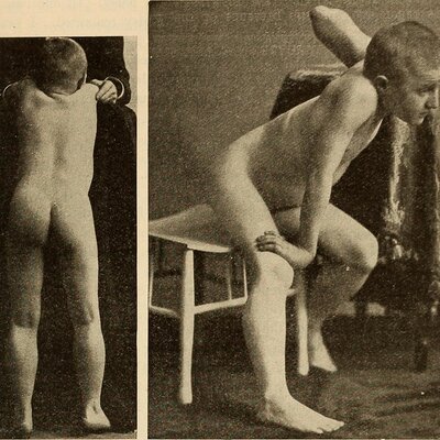 Timeline: Distrofia muscular de Duchenne