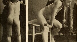 Timeline: Distrofia muscular de Duchenne