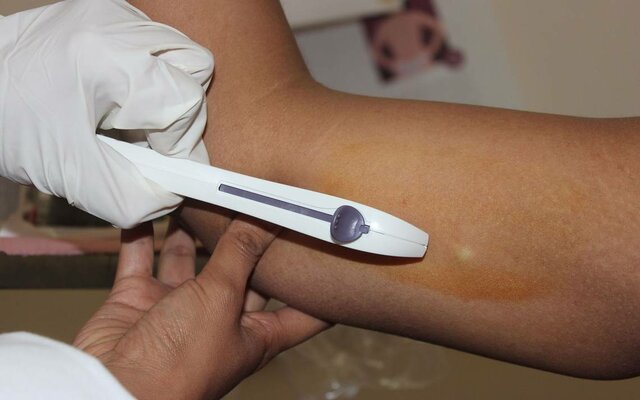 SIGLO XX: Implante subdérmico