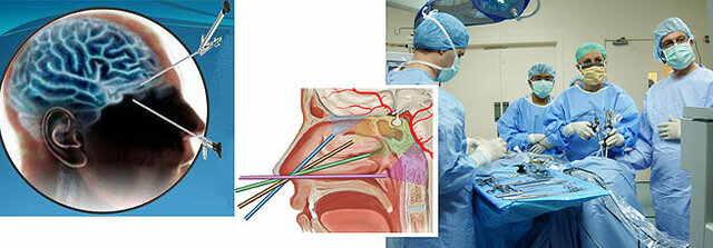 Primera intervención neuroquirúrgica con técnicas galénicas del Nuevo Mundo, en la ciudad de México