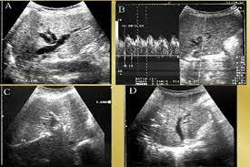 Iniciamos el uso de la ecografía ultrasónica transoperatoria