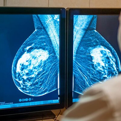 Timeline: TRATAMIENTOS Y MEDICACION CÁNCER DE MAMA