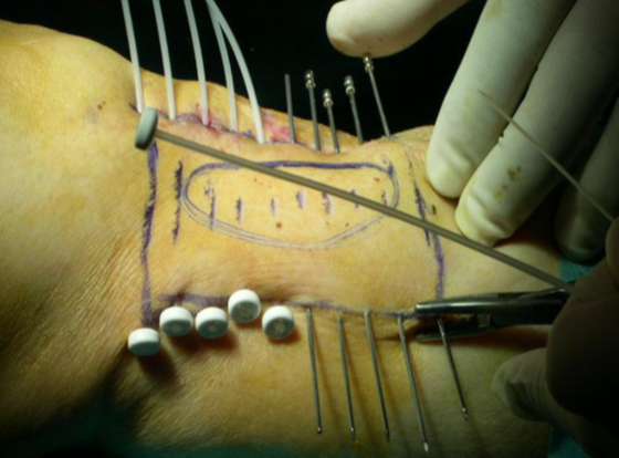 DESCUBRIMIENTO BRAQUITERAPIA