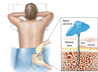 Primer trasplante de la médula ósea