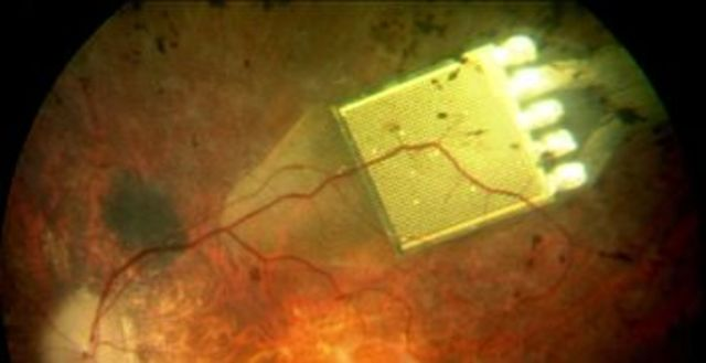 Implante para personas ciegas