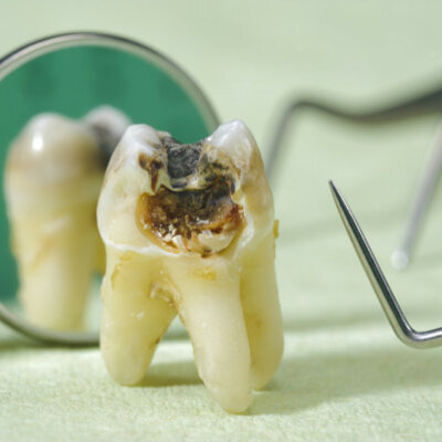 Timeline: Mecanismo de acción de la caries dental