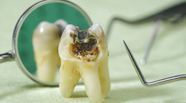 Timeline: Mecanismo de acción de la caries dental