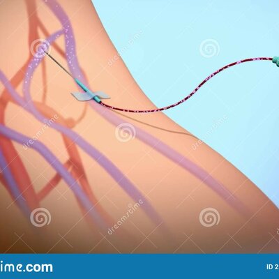 Timeline: Evolución de los accesos vasculares