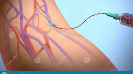 Timeline: Evolución de los accesos vasculares