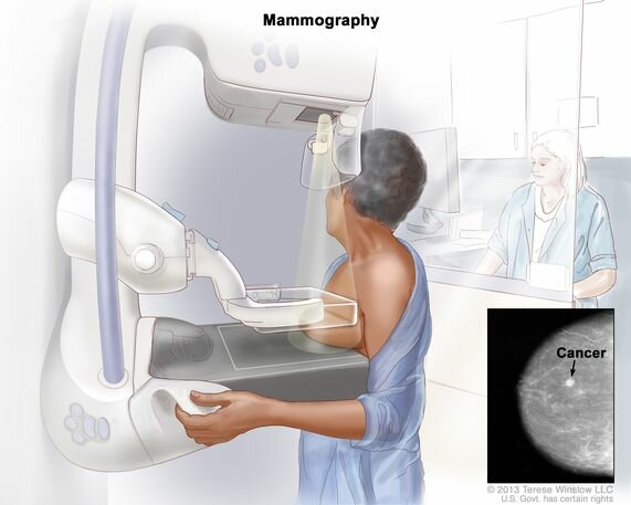 Mammogram Invented