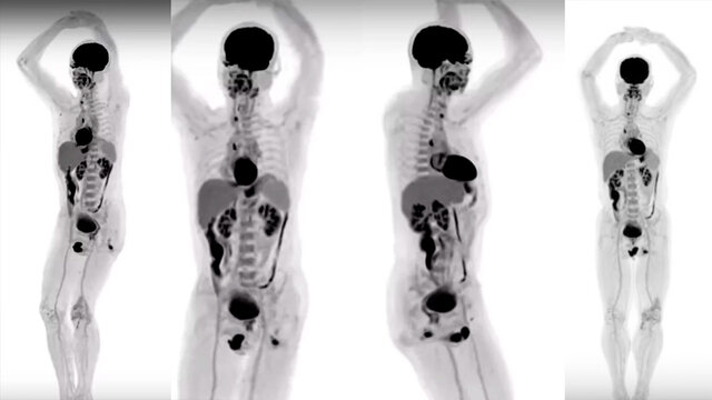 1992 es creado el primer escáner de cuerpo completo: