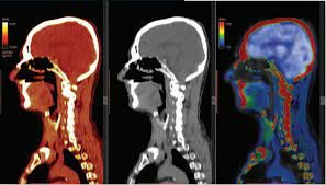 PET- Positrones y cáncer cerebral
