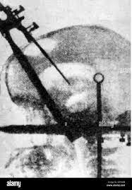 Densitometría ósea- Radiografías