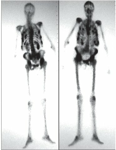 Gammagrafía- Aparición de los generadores