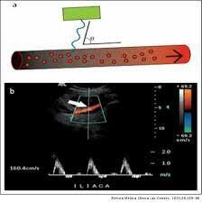 Ultrasonido - Técnica Doppler
