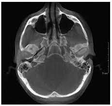 PET - Reconstrucción de Imágenes Tomográficas