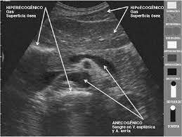 Ultrasonido - Escalas de Grises