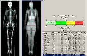 Densitometría ósea - DPA, DEXA