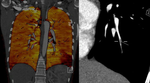TAC - TC con energía dual