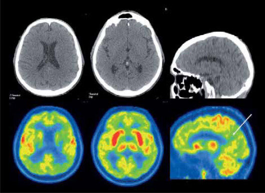 PET: Propiedades de positrones
