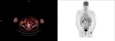 GAMMAGRAFÍA: Tratamiento de cáncer