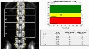 DENSITOMETRÍA ÓSEA: Densitometría Fotónica Dual