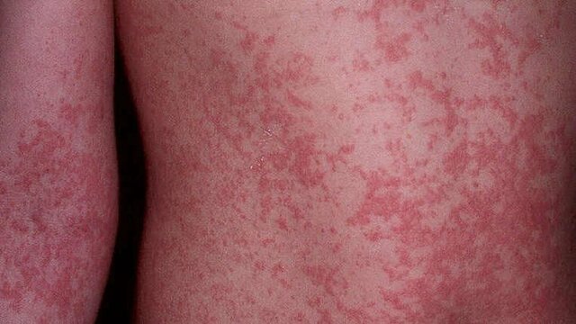 Brote de infección viral:ZIKA