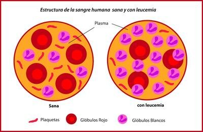 Terapia genética contra leucemia