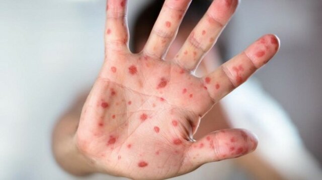 La creació de la vacuna contra rubèola