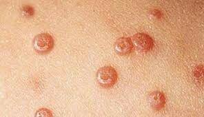 La creacó de la vacuna contra papil·loma