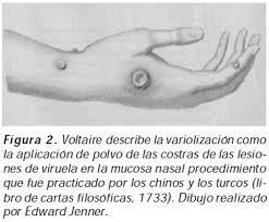 Voltaire describe la variolización