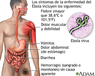 Infección del virus Ébola