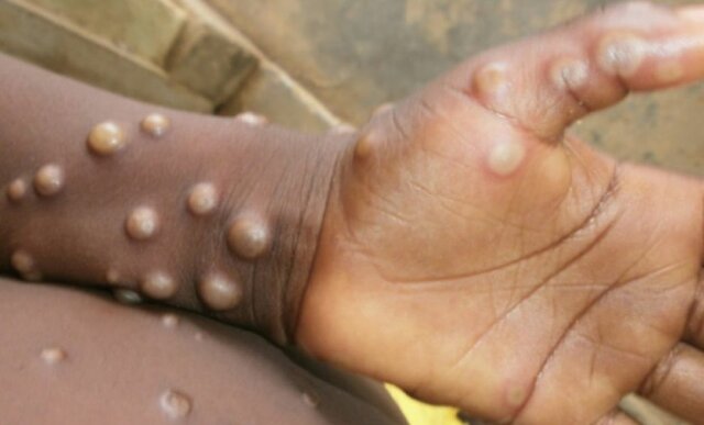 Se erradicó la viruela y el paludismo .