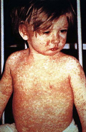 Measles Outbreak