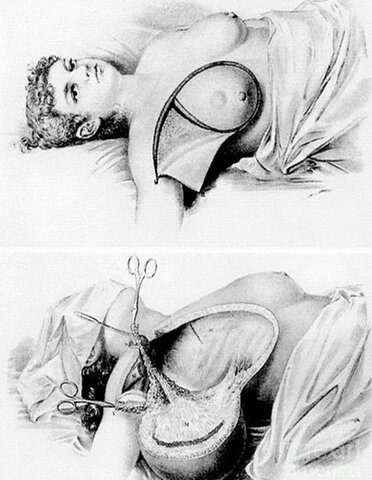 William Halsted - Mastectomía radical