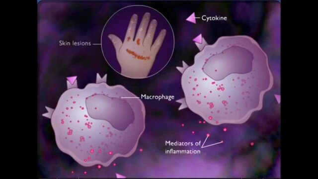 Hipersensibilidad retardada