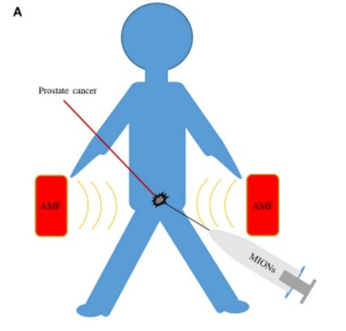 Hipertermia magnética dirigida biologicamente: Potencial y limitaciones